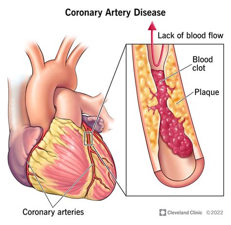Coronary Artery Disease CAD Symptoms Treatment