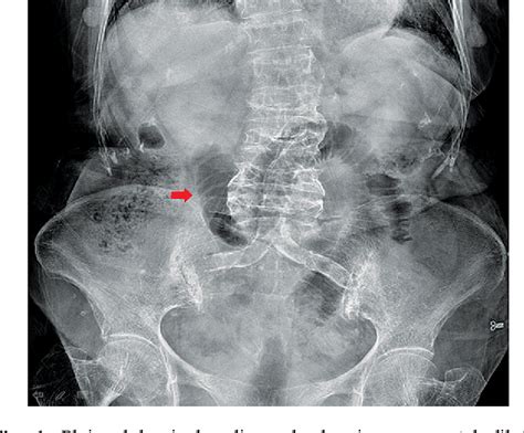Figure 1 From Obturator Hernia A Rare Cause Of Acute Small Bowel