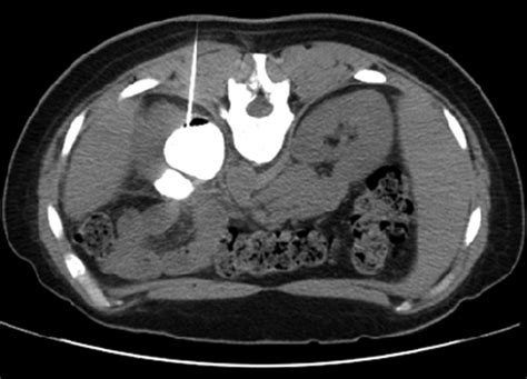 Duplicated Ectopic Ureter With Vaginal Insertion 3d Ct Urography With