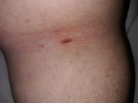 I Woke Up With A Bruise Similar To Having Blood Drawn In The Crease Of