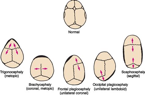 Abnormal Head Shape Visual Diagnosis And Treatment In Pediatrics 3 Ed