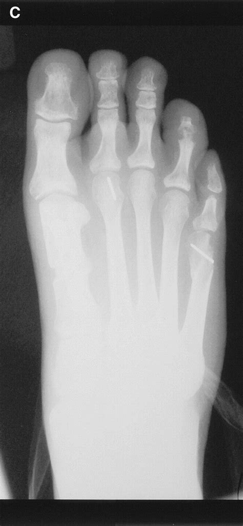 Salvage Of Complications Of Hallux Valgus Surgery Foot And Ankle Clinics