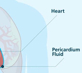 Maybe you would like to learn more about one of these? Top Mesothelioma Treatment Options for the Best Prognosis