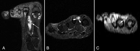 Magnetic Resonance Imaging Of A Deep Peroneal Intraneural Ganglion Cyst