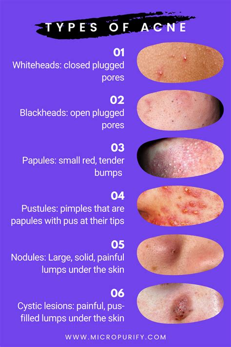 What Type Of Acne Do You Have Types Of Acne Papules Acne Lotion