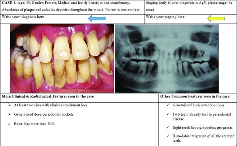 A Sample Case Of Chronic Periodontitis Included In The Case Document