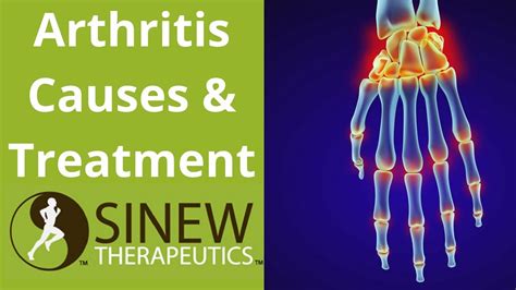 Arthritis Causes And Treatment Youtube