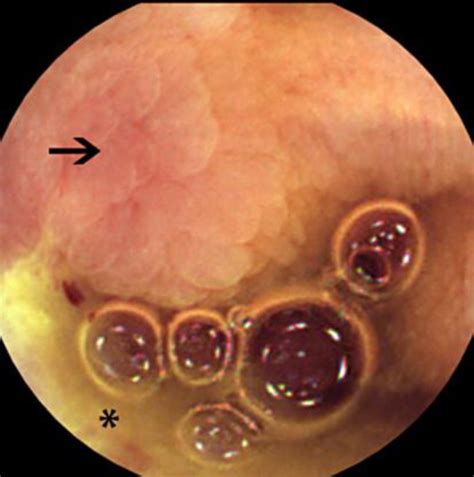 Capsule Endoscopy Image To Evaluate Small Bowel Involvement Capsule Download Scientific
