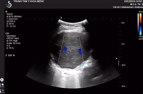 Vietnamese Medic Ultrasound Case 578 Cystic Teratoma Of The Lung Dr