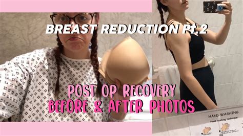 Breast Reduction Pt Post Op Recovery Before After Photos Vlog