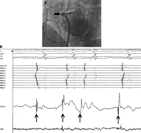 Ectopic Focus In An Accessory Left Atrial Appendage Circulation