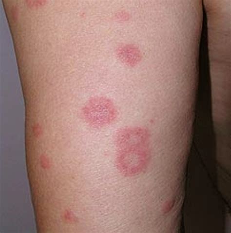 Erythema Multiforme Pictures Treatment Symptoms Causes