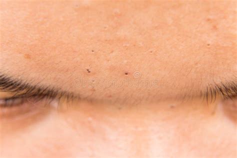 Ugly Pimples Acne Zit And Blackheads On The Forehead Of A Teenager