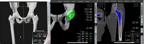 Robotic Total Hip Replacement Surgery Robotic Prosthetic Surgery