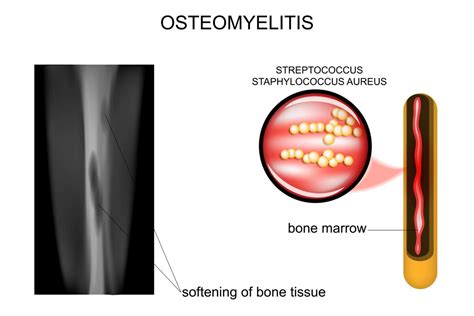 What Is Osteomyelitis What Causes It And How Is It Treated