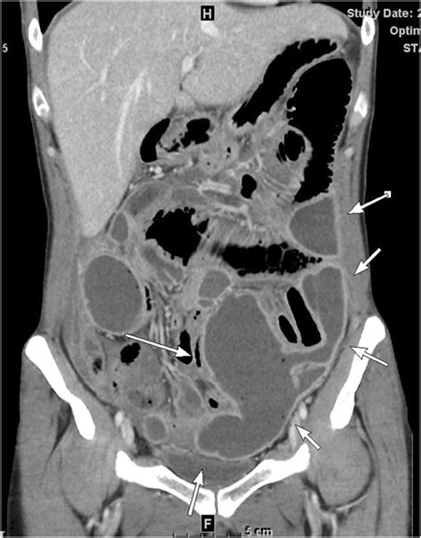 Abdominal Computed Tomography Ct Scan An Abdominal Ct Scan Showed A