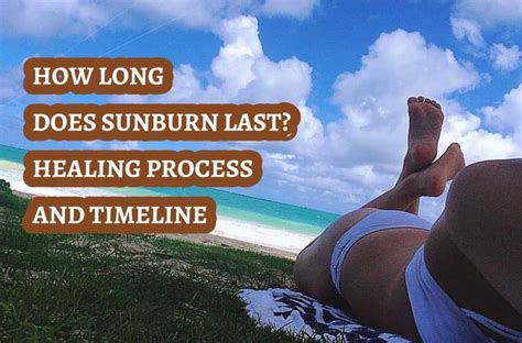 How Long Does Sunburn Last Healing Process And Timeline Tanner Skin