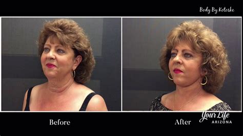 Roll Back The Years With The Quicklift® Face Lift Youtube