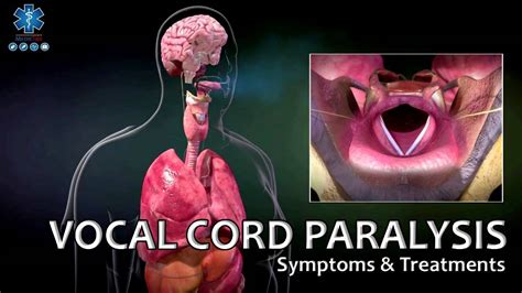 Vocal Fold Paresis