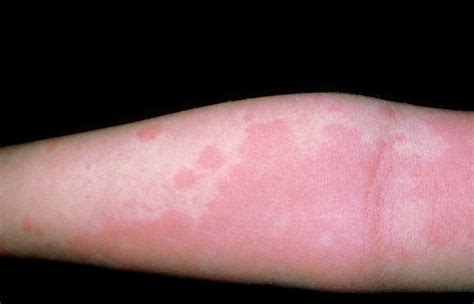 Urticaria Rash On Arm Photograph By Dr P Marazziscience Photo Library