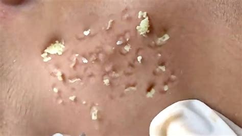 This Pimple Popping Method Will Leave You Speechless Part 39 Youtube