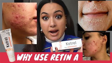 Why Use Tretinoin Cream Retinoids For Acne My Adult Acne Journey