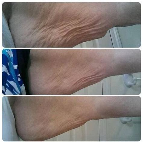 Nerium Firm Helps With Loose Sagging Skin Great Results On This Arm