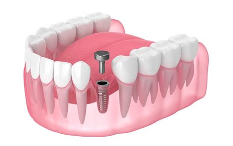 What Is A Healing Cap On A Dental Implant Hanna Dental Implant Center