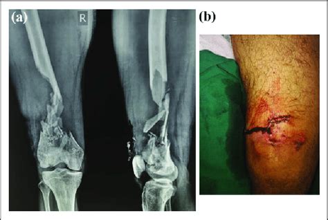 A Right Distal Femur Fracture With Articular Comminution And Download Scientific Diagram