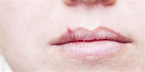 You Never Knew Your Lip Reveals A Lot About Your Health Know Here