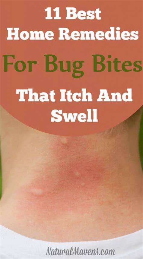 11 Best Home Remedies For Bug Bites That Itch And Swell Natural Mavens