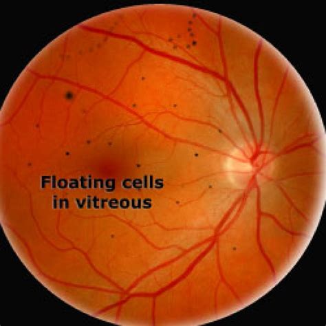 Posterior Vitreous Floaters