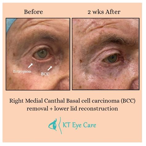 Basal Cell Carcinoma Bcc