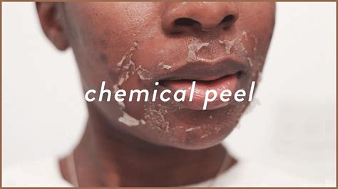 I Tried The Strongest Vi Peel 😰 Chemical Peel Before And After For