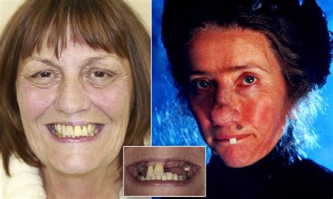 Preston Woman Wins £35k After Losing 13 Teeth Following Botched Dental