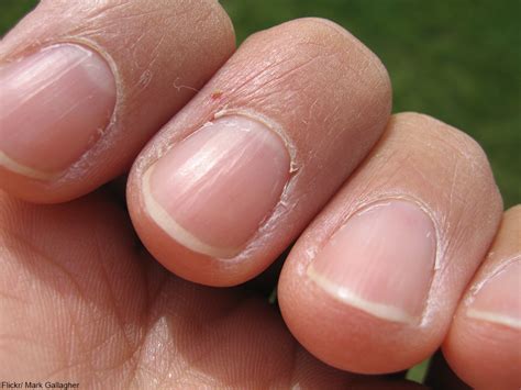 Diseases And Medical Disorders That Show Up In Your Nails First Dusty Old Thing