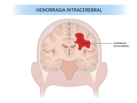 Hemorragia Intracerebral Aurora Health Care