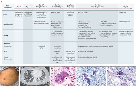 Mmr Vaccineassociated Disseminated Measles In An Immunocompromised