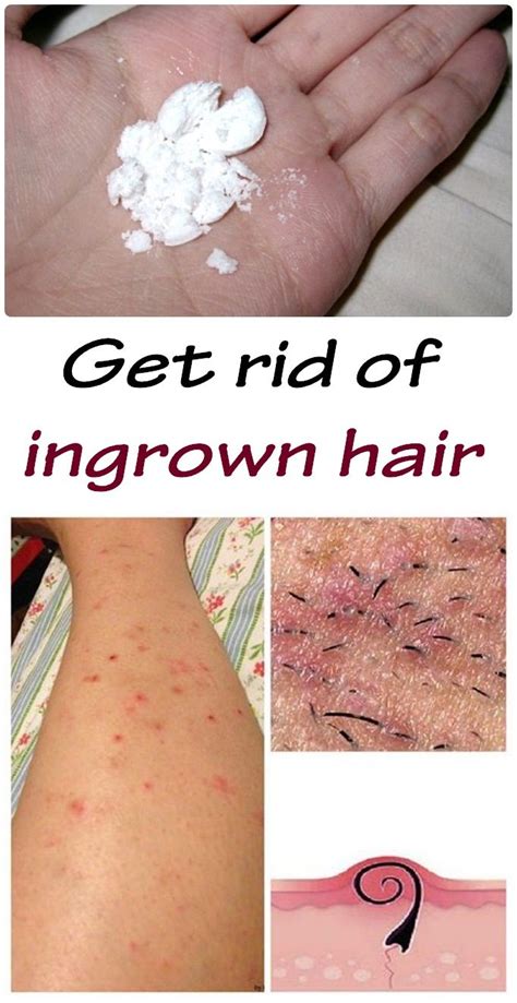 How To Remove Ingrown Hair Galhairs
