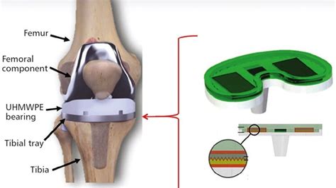 Smart Self Powered Knee Implants Tech Briefs
