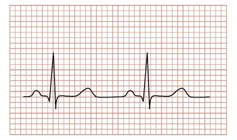 Siete Preguntas Y Sus Respuestas Sobre El Electrocardiograma Del