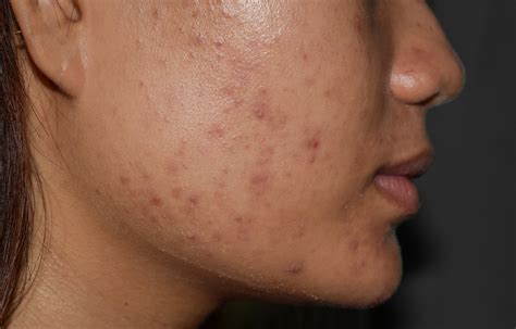 Post Inflammatory Hyperpigmentation Caused By Acne Sozo Clinic
