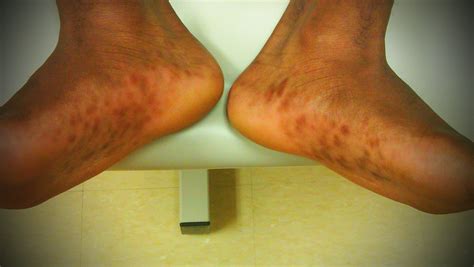 Case A 16 Year Old Male Complains Of A Rash On Both Hands And Feet