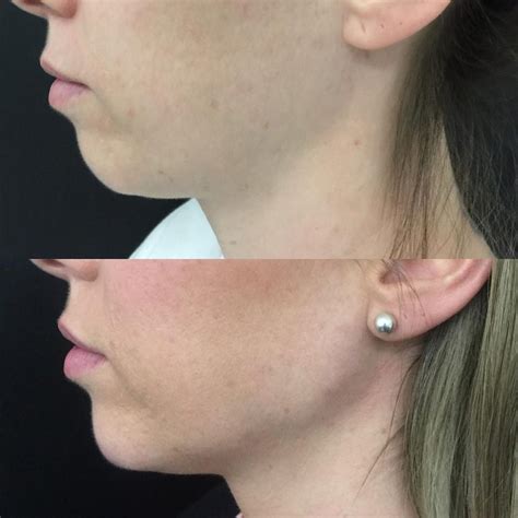 Non Surgical Jowl Lift Thread Lift Hifu Injectables And Fillers For Jowl