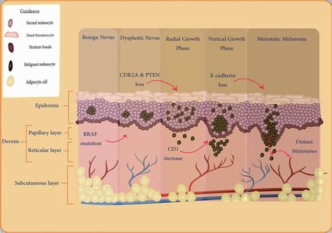 Stages Of Melanoma Growth Patterns And Stages Of Skin Cancer The Best