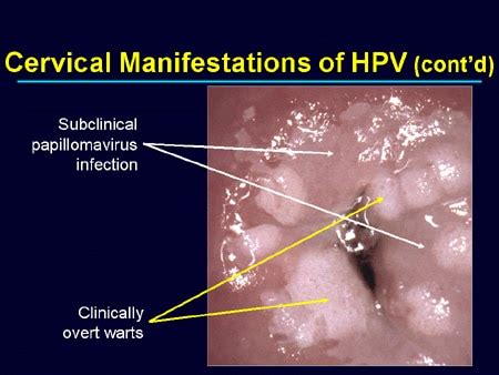 Preventing Cervical Cancer And Other HPV Related Diseases