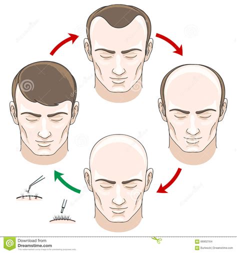 Hair loss, otherwise known as alopecia in medical nomenclature, is a phenomenon that we all (if we live for excessive hair loss or pattern baldness which has already progressed into the later stages. Stages Of Hair Loss, Treatment And Transplantation Stock ...