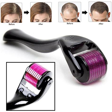 Medications are available to treat pattern (hereditary) baldness. 540 Micro-needling Derma Roller Hair Beard Regrowth Anti ...