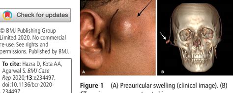 Figure 1 From Post Traumatic Preauricular Pulsatile Swelling In A