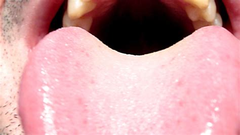 Tongue Discoloration - Your Dental Health Resource